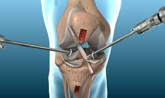 ACL Reconstruction Surgery in HSR Layout