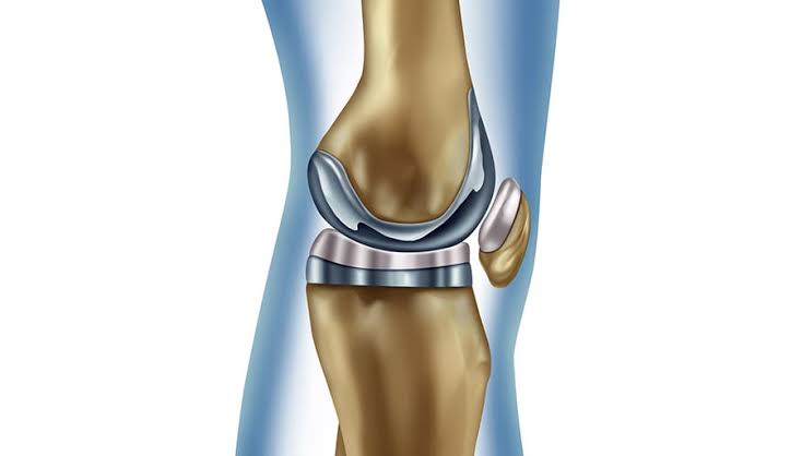 Why Arthritis Leads to Knee Replacement—And What You Can Do Early On