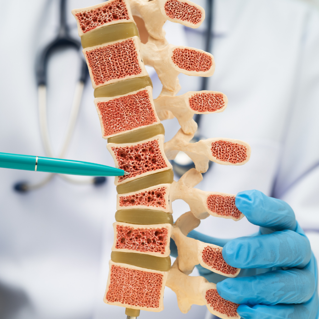 Bone Doctor Bangalore Explains Early Signs of Osteoporosis