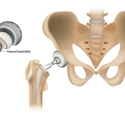 Hip Replacement