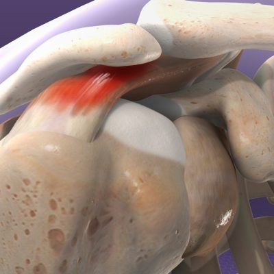 Subacromial Decompression