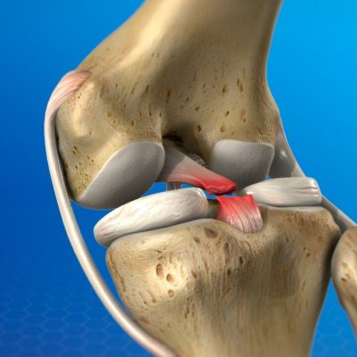 PCL Reconstruction